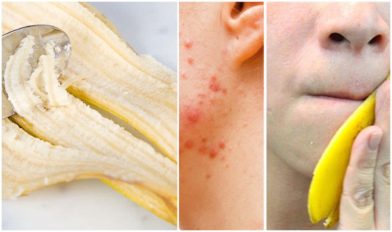 8 Wonderful Methods To Use Banana Peel For Lovely Pores and skin